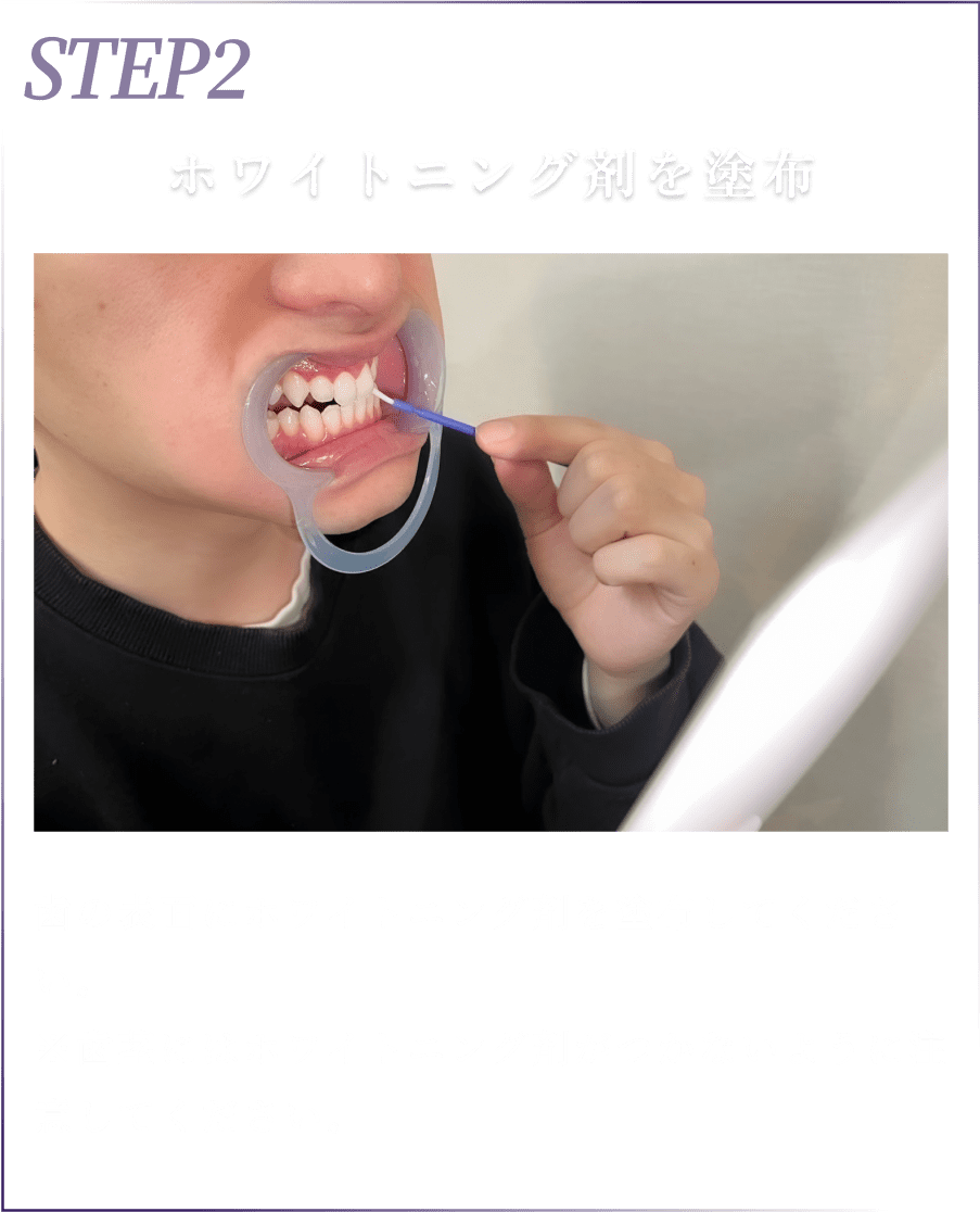 02塗布
          ホワイトニング剤を塗布
          歯の表面にホワイトニング剤を塗布してください。※歯茎にはホワイトニング剤がつかないように注意してください。
          