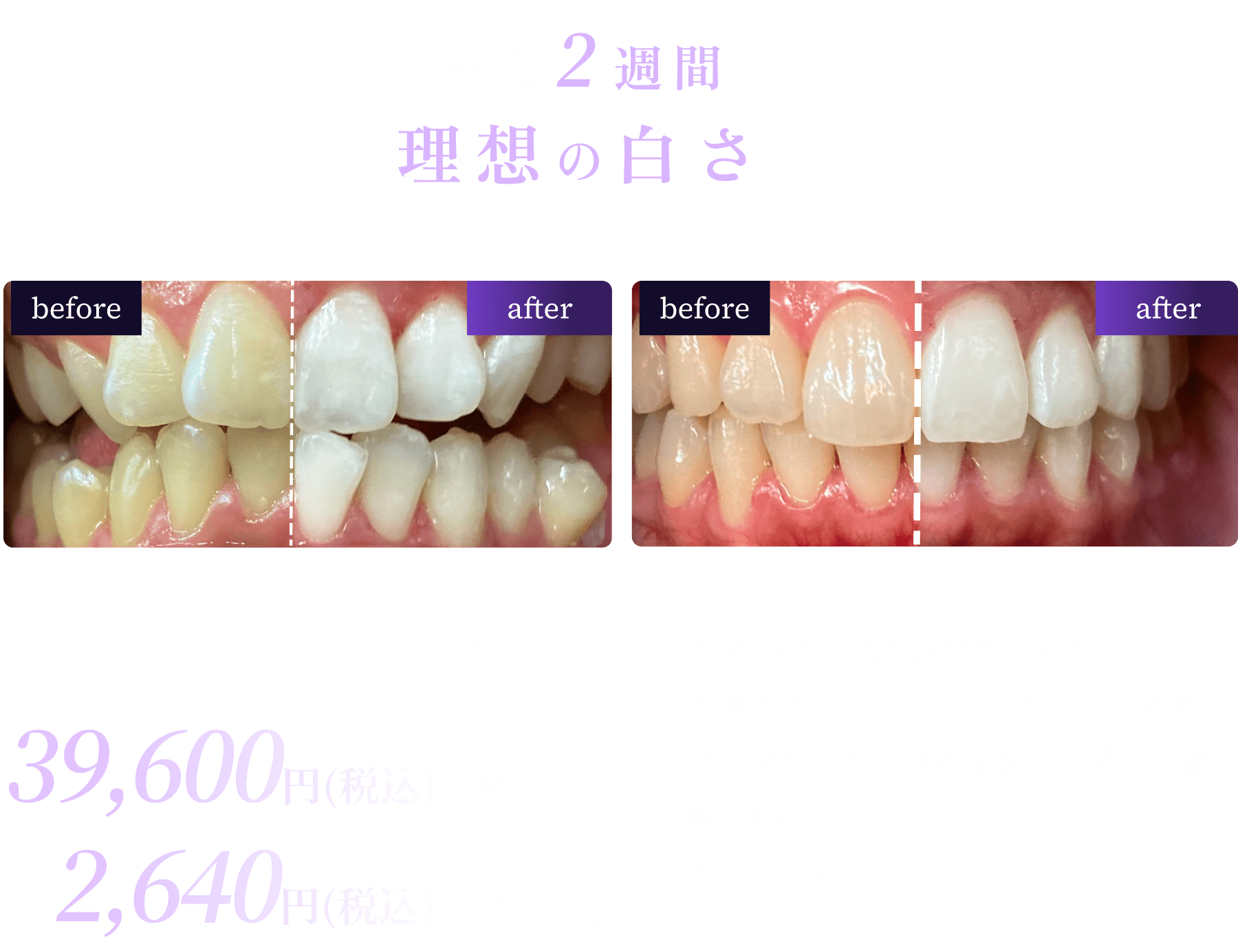 最短2週間で理想の白さに
          ホームホワイトニングセット39,600円(税込)約15回
          ※ 効果には個人差があります
          ※ 副作用(リスク): ホワイトニング後の一時的な知覚過敏症状、一時的な歯茎の沁み
          ※ 月々1,980円〜
          